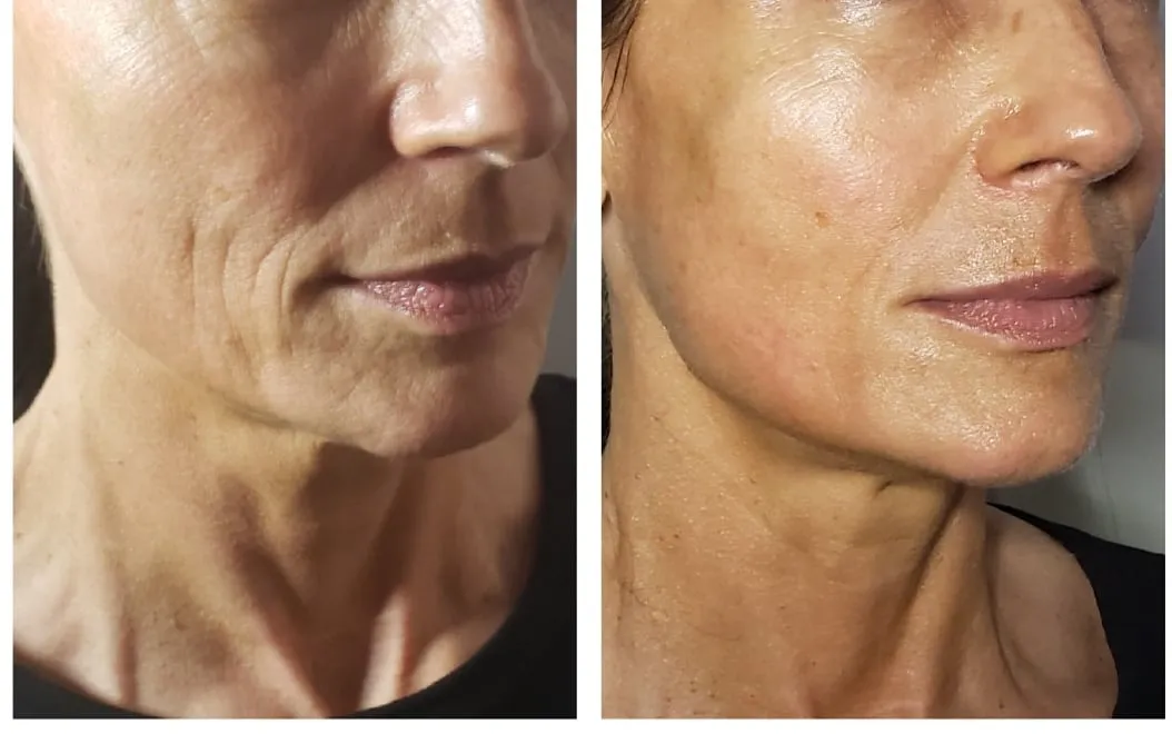 Before and after three-quarter views of woman's lower face and jawline definition