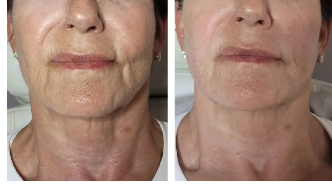 Face and neck-4