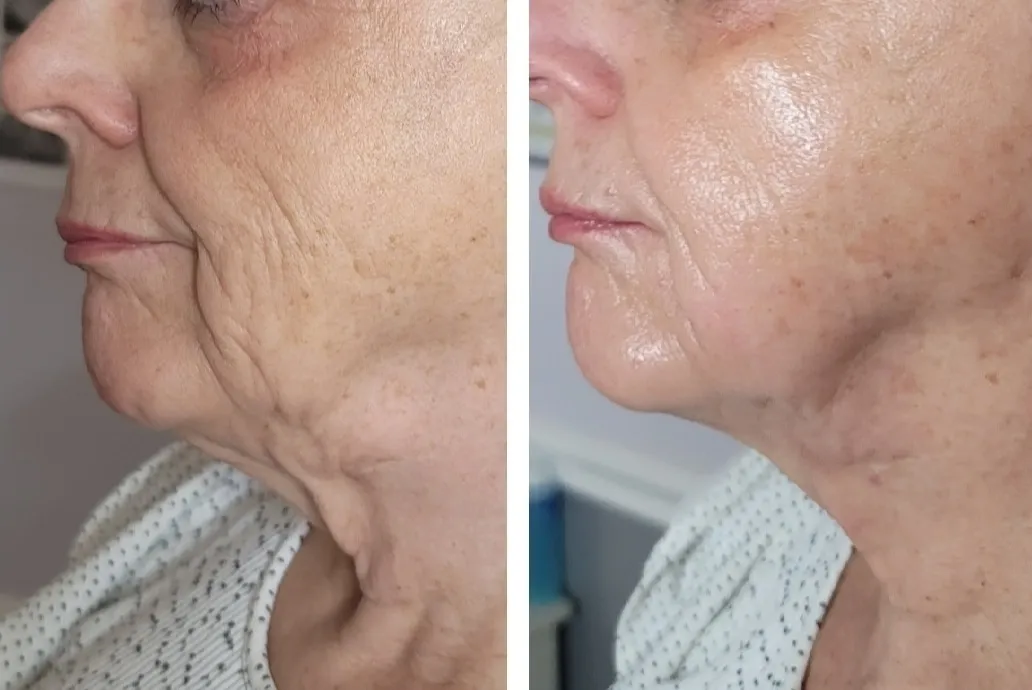 Side profile before and after showing improved jawline definition and reduced skin laxity