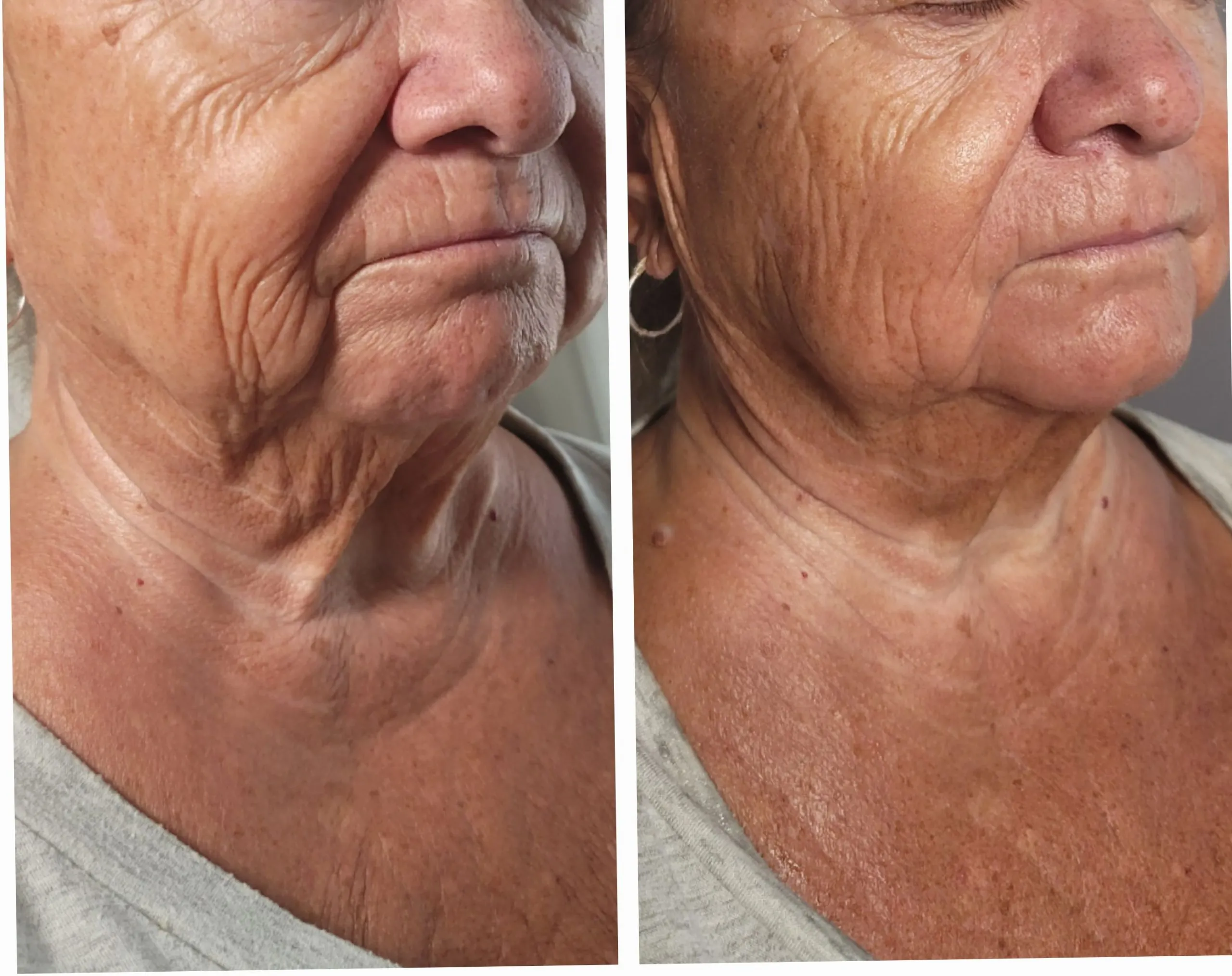 Before and after of neck and jawline showing improved contour and reduced creasing