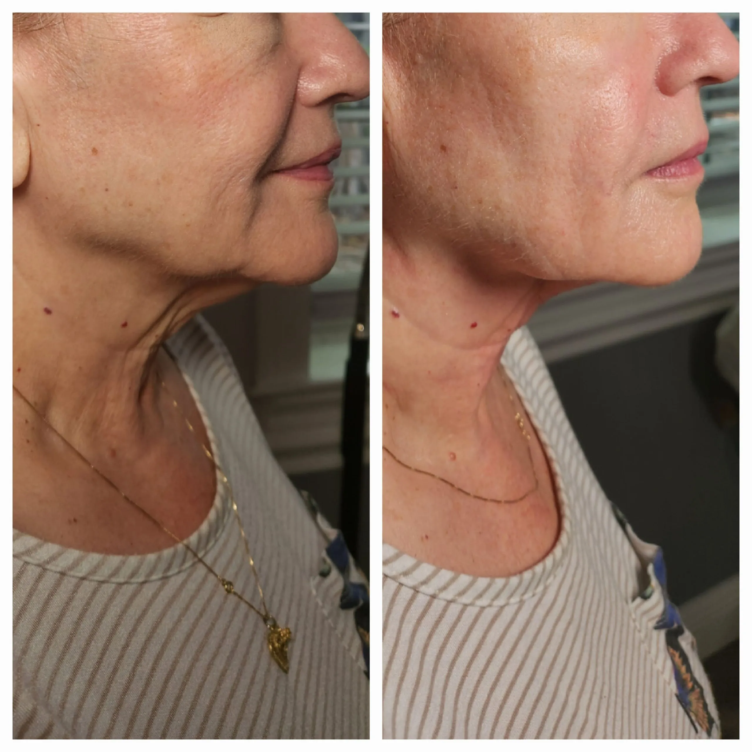 Side profile before and after showing improved neck definition and skin tightness