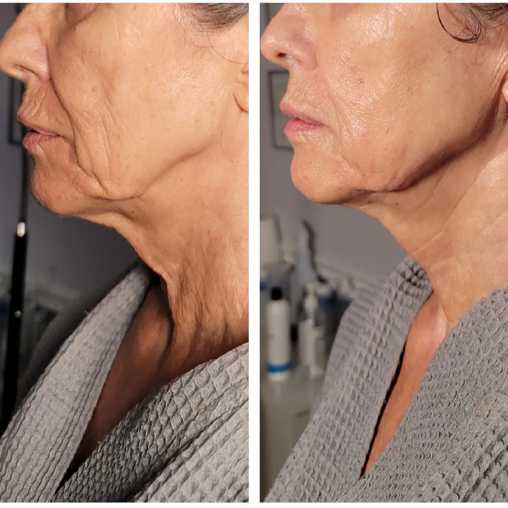 Side profile before and after showing reduced neck sagging and improved skin firmness