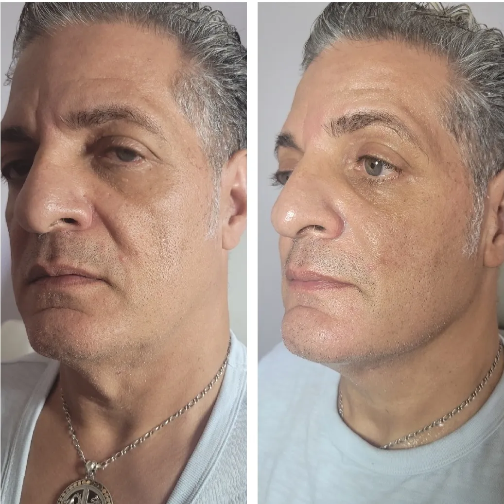 Face and neck-9