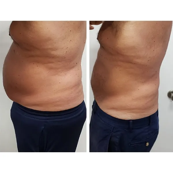 Before and after side-by-side photos of man's abdomen and torso