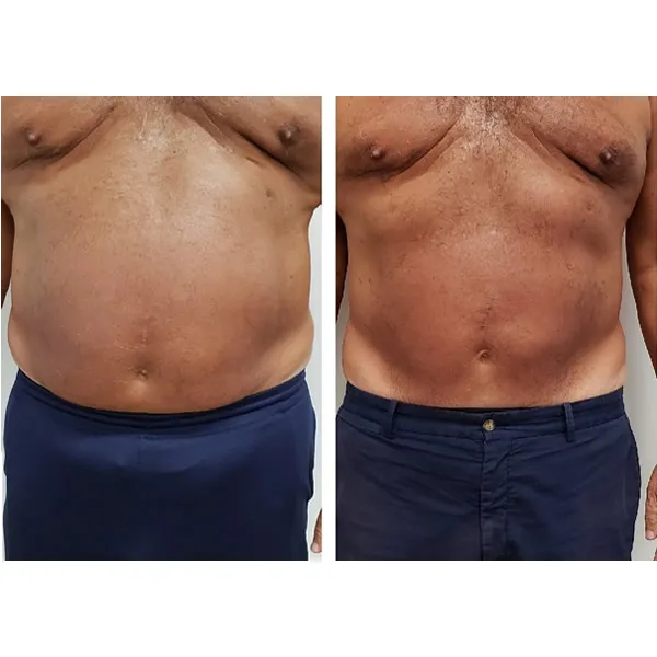 Before and after comparison of male abdomen showing reduced abdominal fat and more defined muscle tone