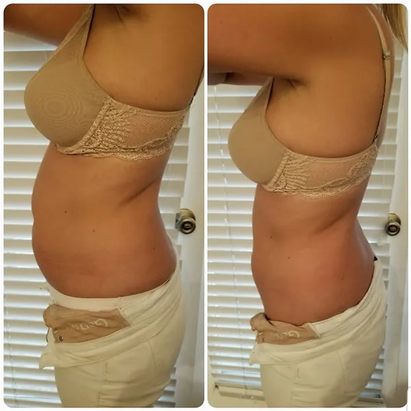 Before and after side-by-side comparison of female torso showing improved abdominal definition and waist contour