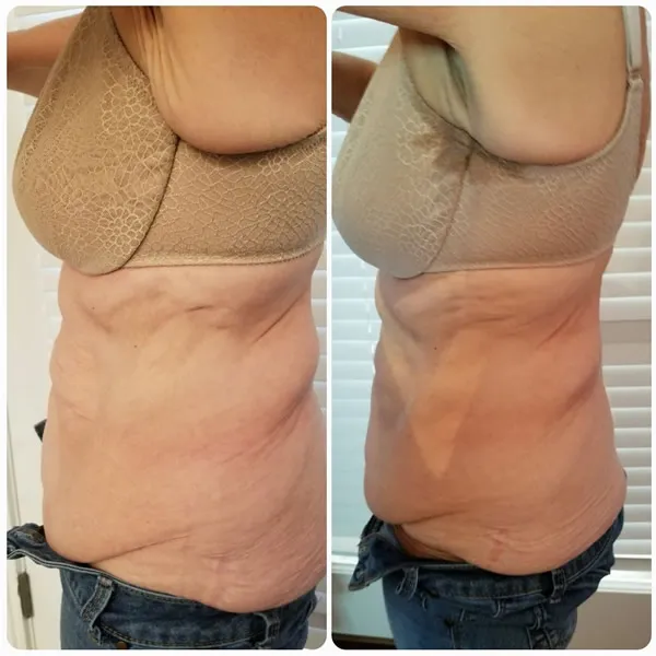 Before and after comparison of female lower abdomen and flanks showing reduced bloating and improved skin texture
