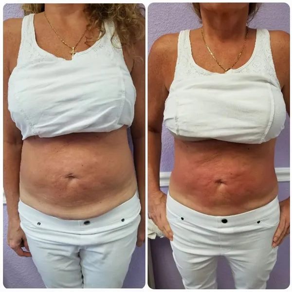 Before and after front-facing comparison of female torso showing firmer abdomen and improved skin laxity