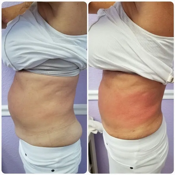 Before and after side profile comparison of female torso showing tightened abdominal skin and enhanced muscle definition