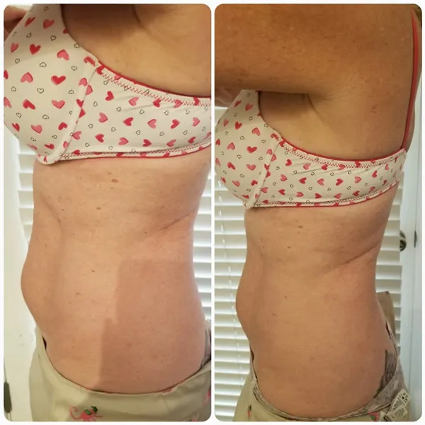 Before and after side comparison of female lower torso showing reduced abdominal bulge and improved skin firmness