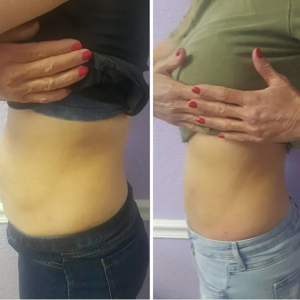 Before and after abdominal area showing reduced appearance of loose skin