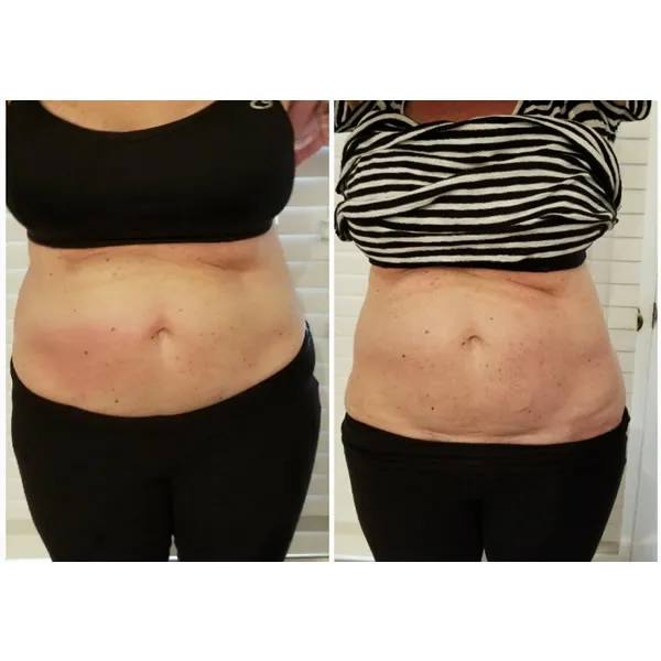 Before and after abdominal area showing improved skin tightness and contour