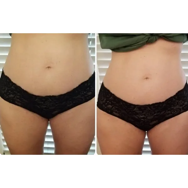 Before and after lower abdomen showing reduced laxity and improved definition