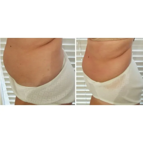 Before and after lower abdominal area showing improved skin firmness