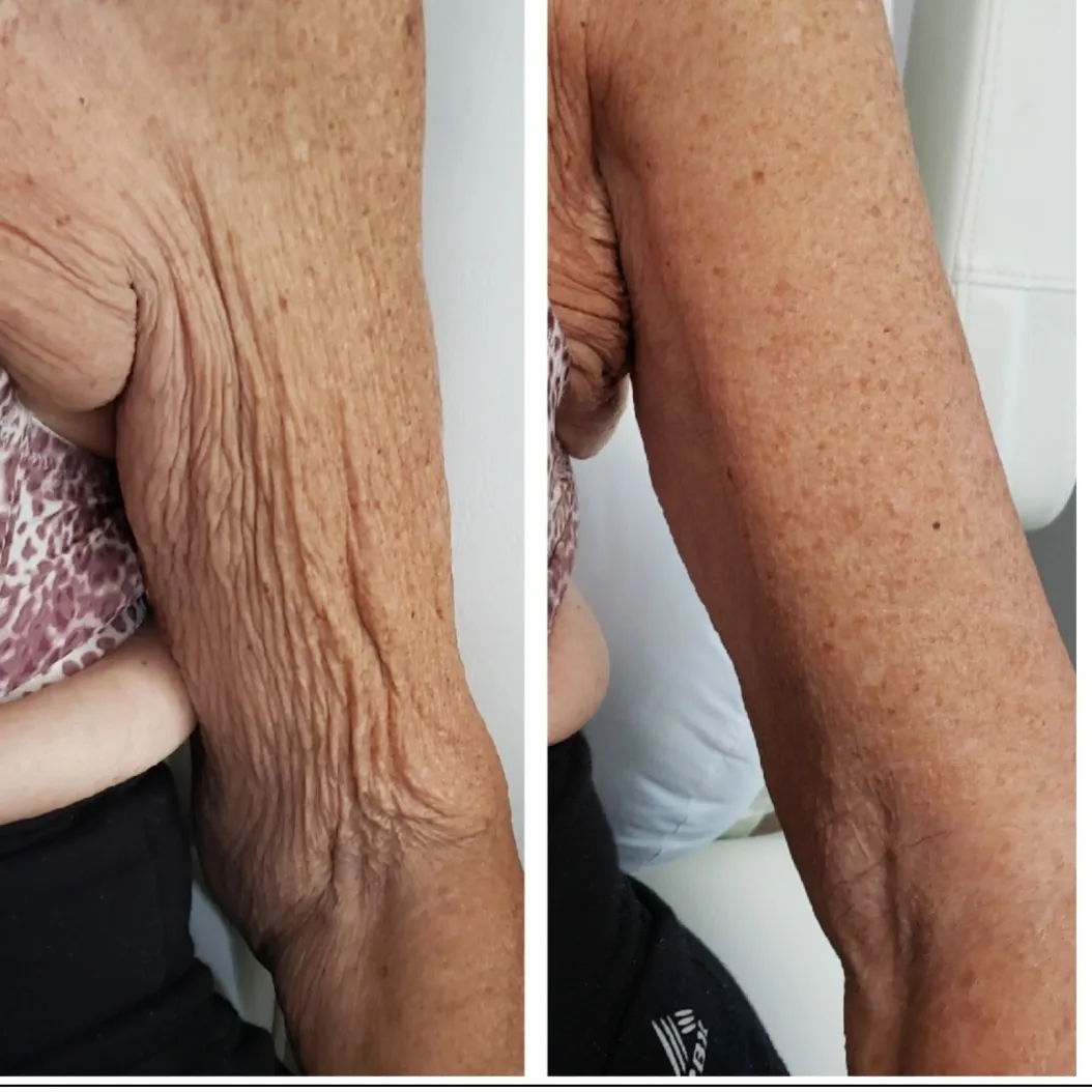 arm-1