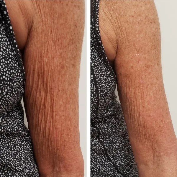 Before and after arm treatment displaying reduced wrinkles and improved skin appearance
