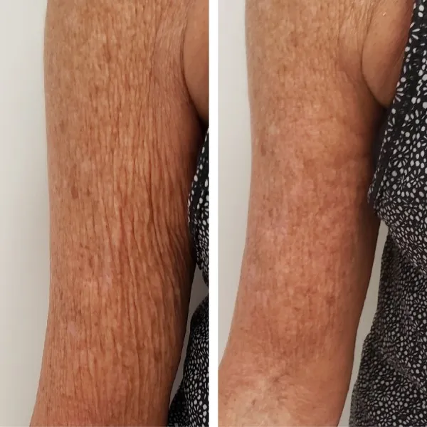 Before and after arm treatment showing decreased crepey skin and enhanced firmness