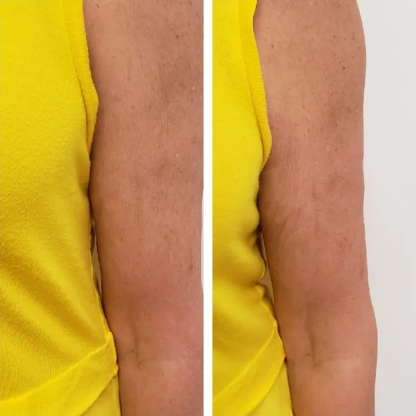 Before and after arm treatment demonstrating improved skin smoothness and reduced texture