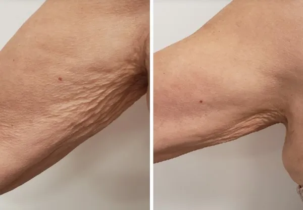 Before and after arm treatment showing reduced skin texture and improved elasticity