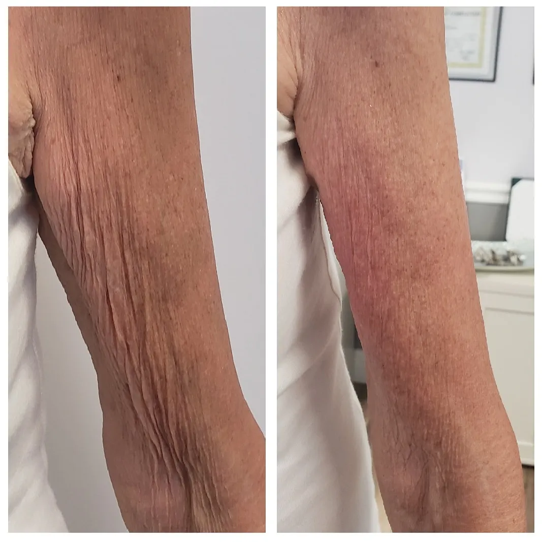 arm-2