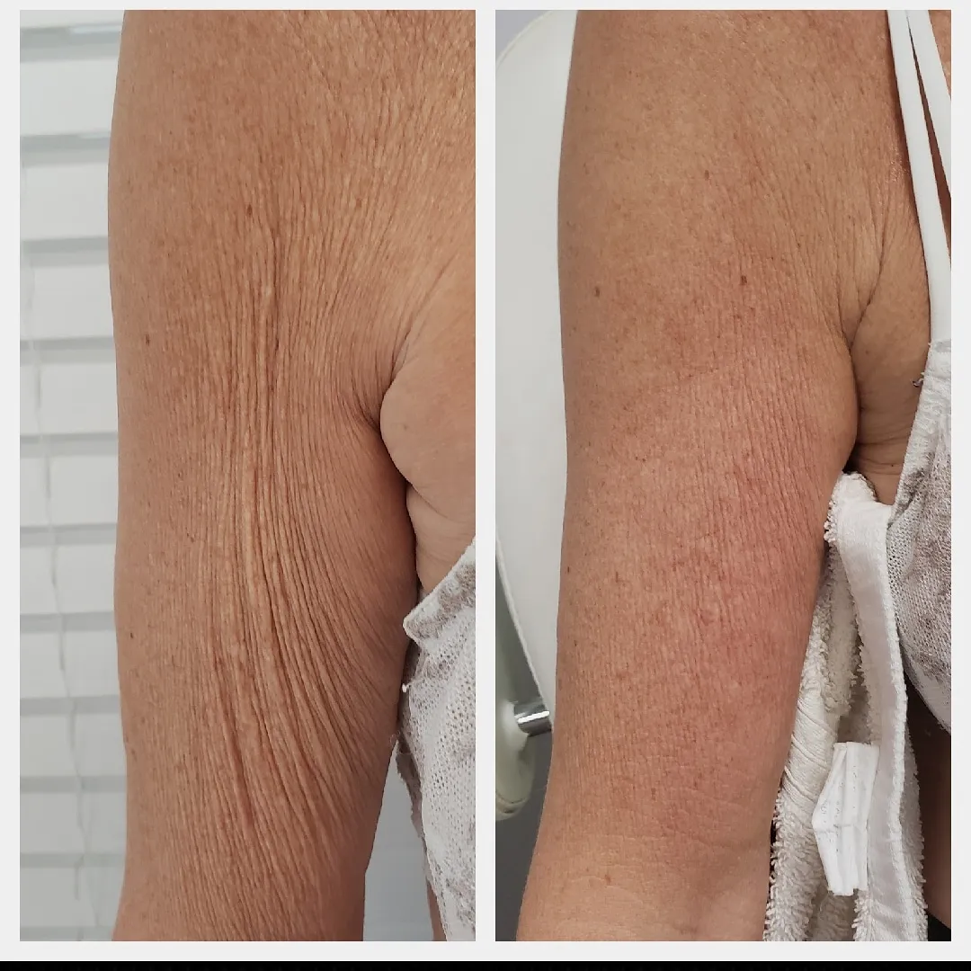 arm-3
