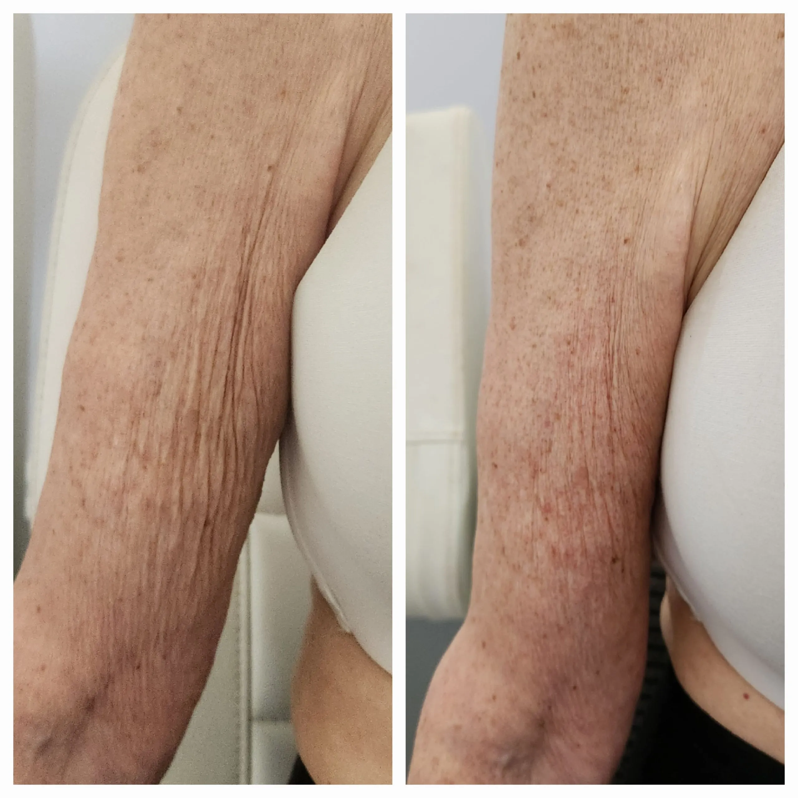 arm-4