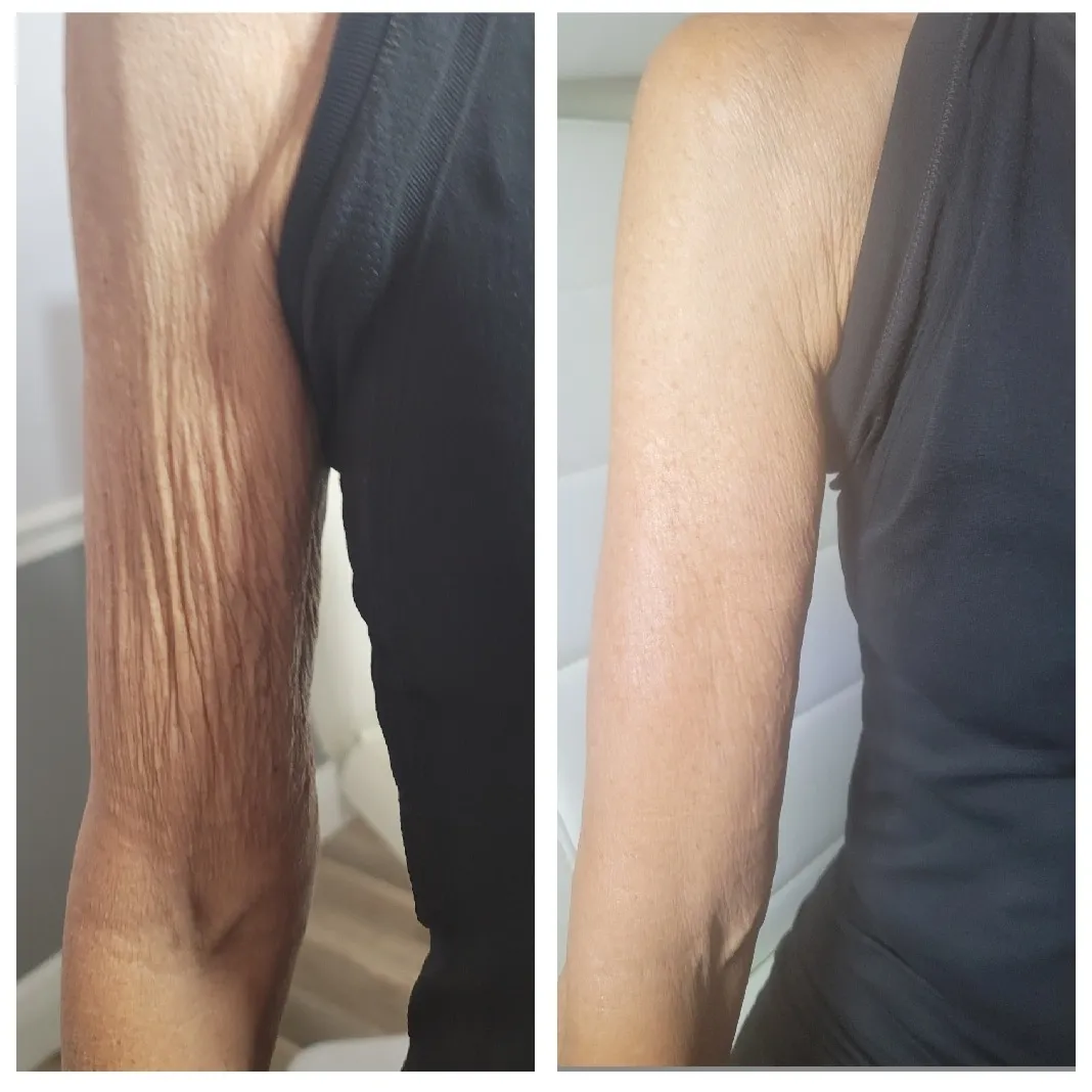 arm-5