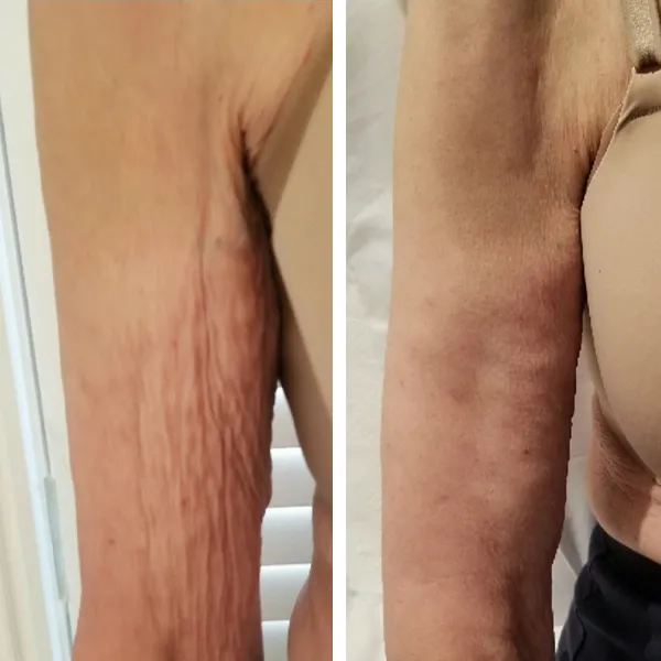 arm-6