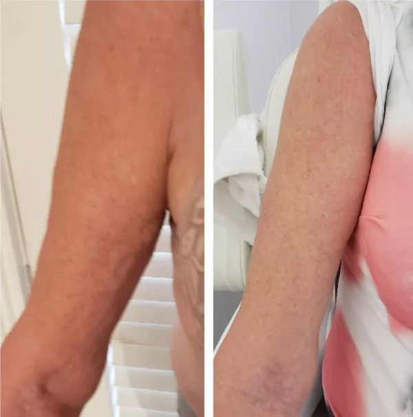 Before and after arm treatment showing smoother skin texture and enhanced skin quality