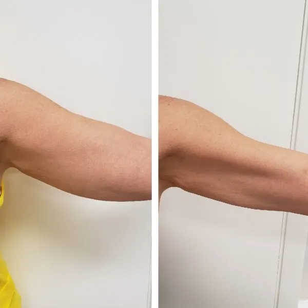 Before and after arm skin tightening showing reduced loose skin and improved firmness