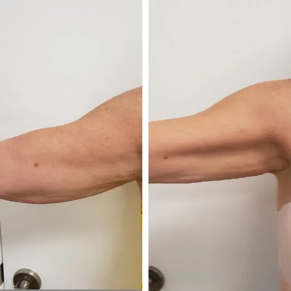 Before and after arm contouring showing tighter, more toned upper arm appearance