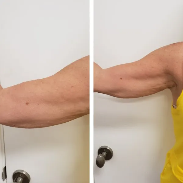 Before and after arm toning treatment showing reduced sagging and improved muscle definition