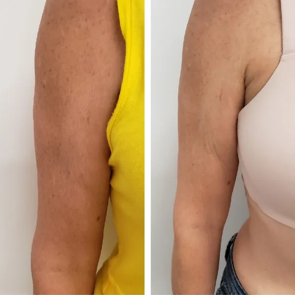 Before and after full arm aesthetic treatment showing improved tone and reduced laxity