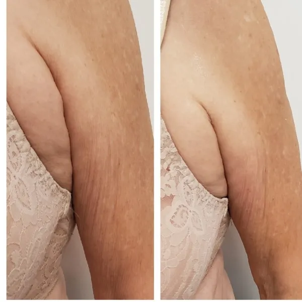 Before and after arm rejuvenation showing smoother skin texture and tightened appearance