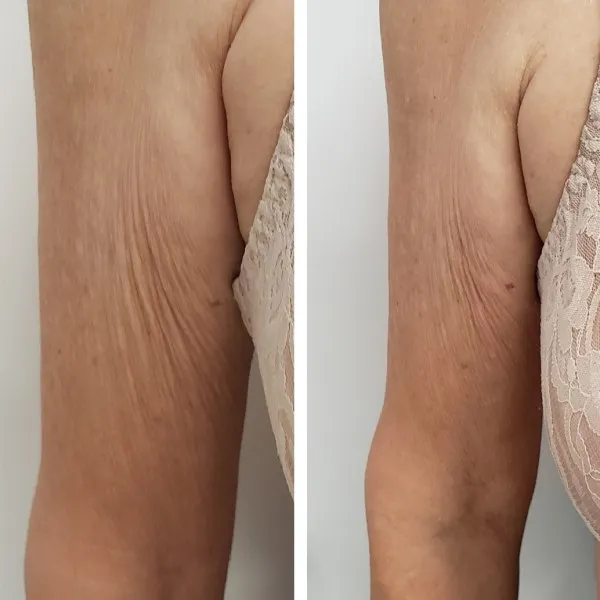 Before and after comparison of arms showing reduced skin laxity and improved firmness