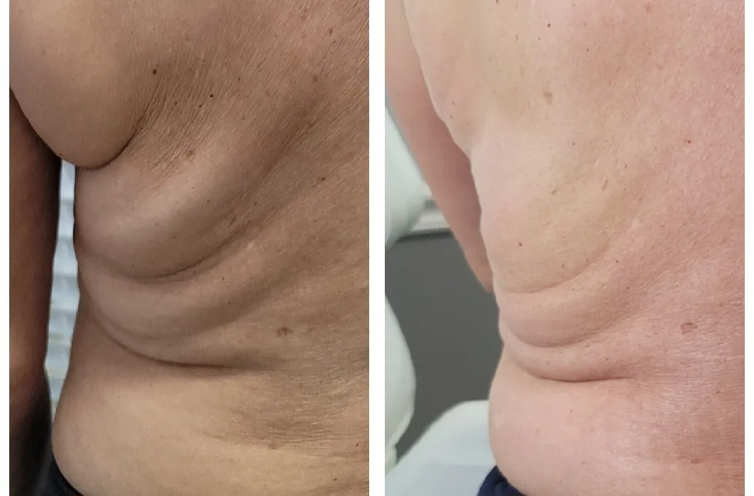 Before and after comparison of flank area showing reduced skin texture and improved appearance on the right side