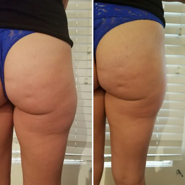 Before and after comparison of buttocks and thighs showing enhanced contour and firmness on the right side