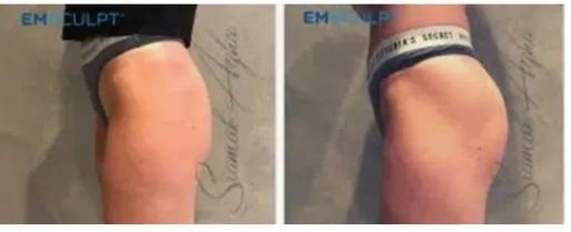 Before and after comparison of buttocks with measurement band showing improved contour