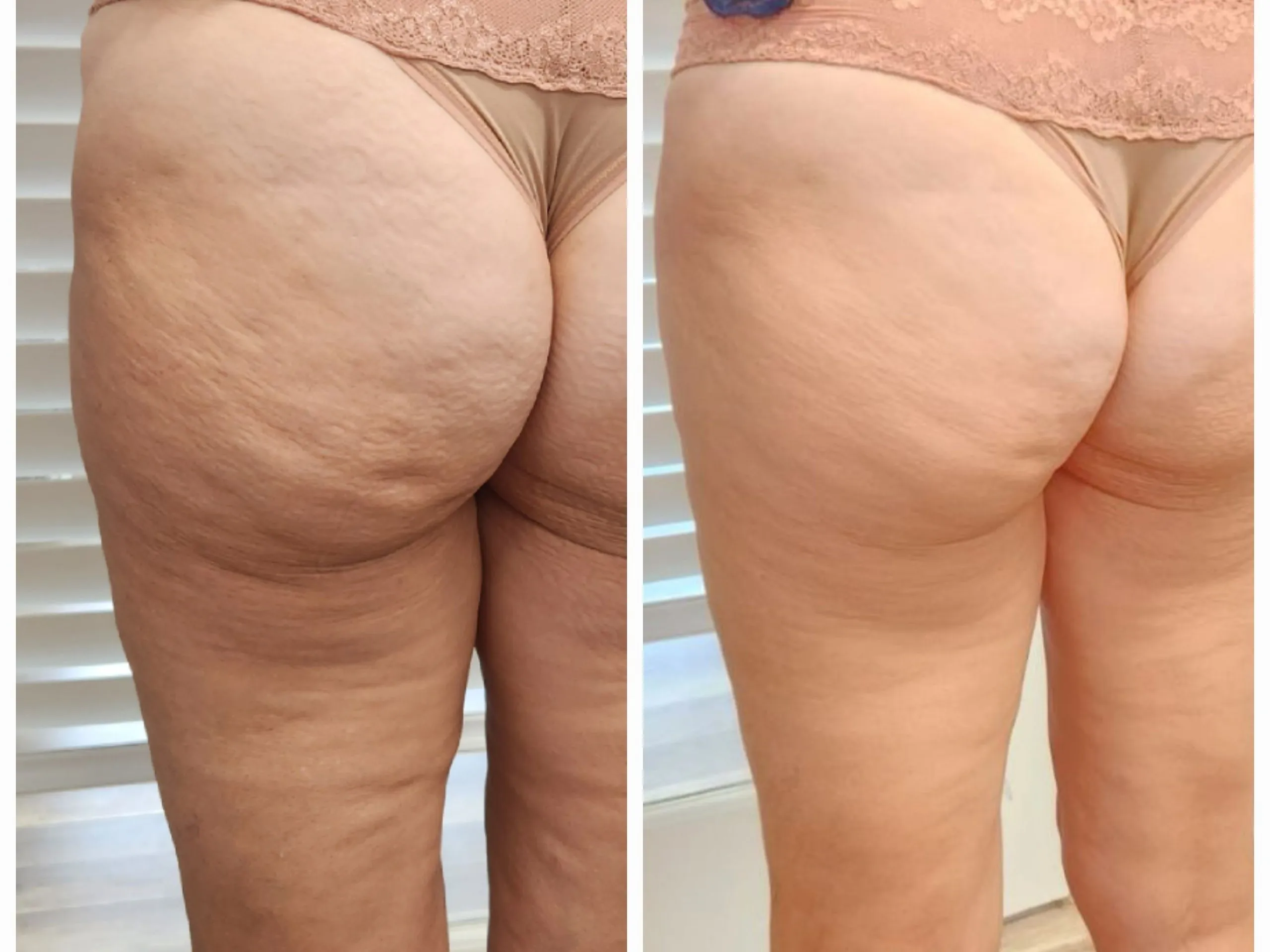 Before and after comparison of buttocks and thighs showing reduced cellulite and improved skin smoothness