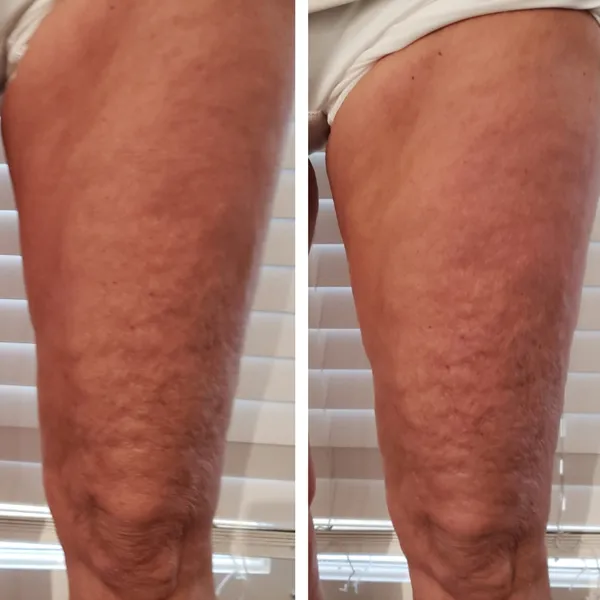 Before and after comparison of thighs showing reduced cellulite appearance on the right side