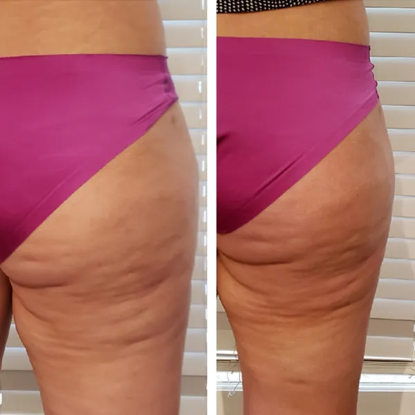 Before and after comparison of thighs showing reduction in cellulite appearance