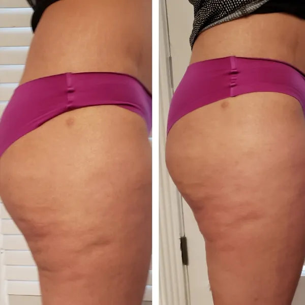 Before and after comparison of buttocks and thighs showing improved skin texture