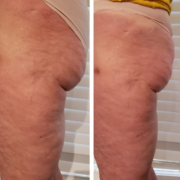 Before and after comparison of buttocks showing improved skin firmness and reduced cellulite