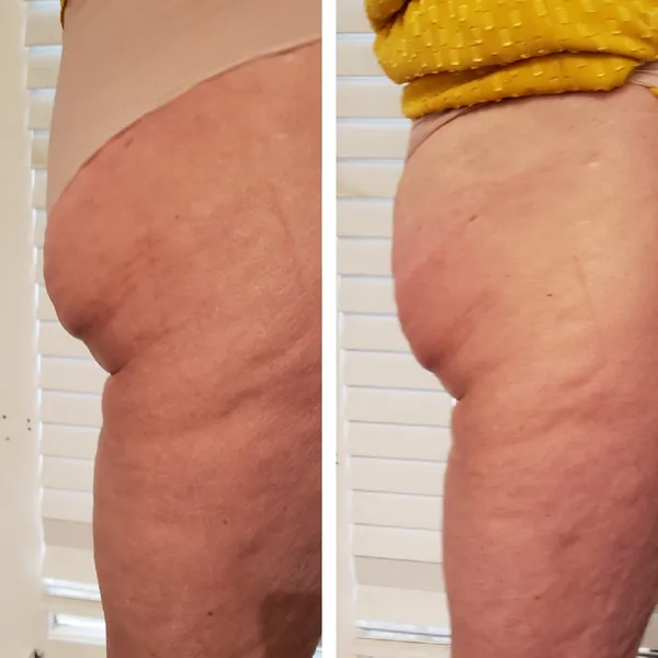 Before and after comparison of buttocks showing improved skin tone and reduced cellulite