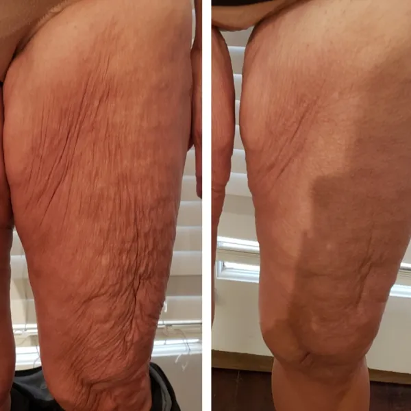 Before and after comparison of thigh skin texture showing reduced wrinkles and crepiness