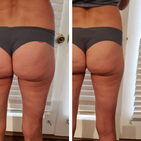 Before and after comparison of buttocks and thighs showing improved skin texture and contour
