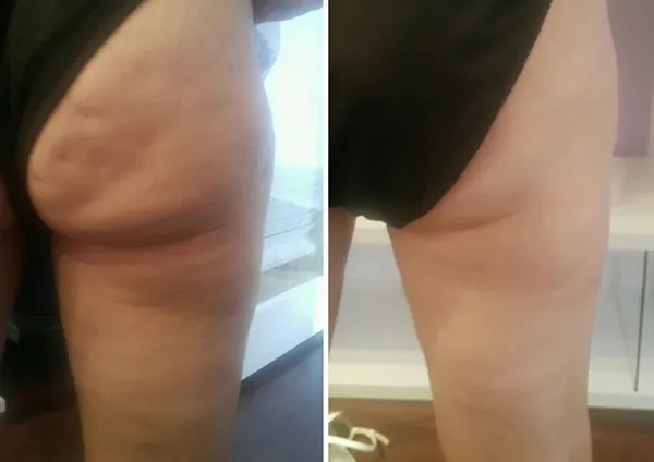 Before and after side-view comparison of thigh showing reduced cellulite appearance