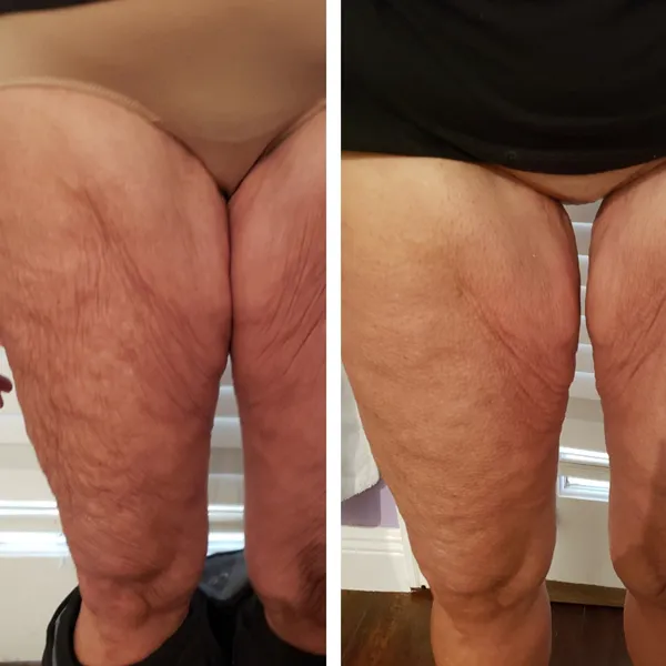 Before and after comparison of thighs showing improved skin texture and reduced dimpling