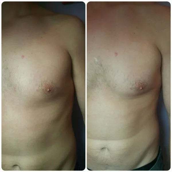 Before and after comparison of male chest showing reduced gynecomastia