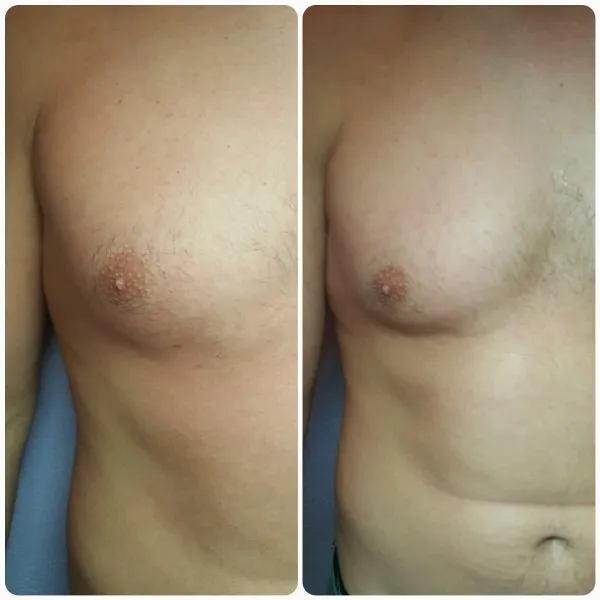 Before and after side-by-side comparison of male chest contour improvement